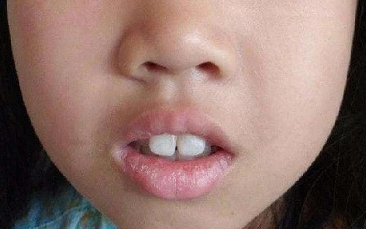 腺体肥大的孩子面容